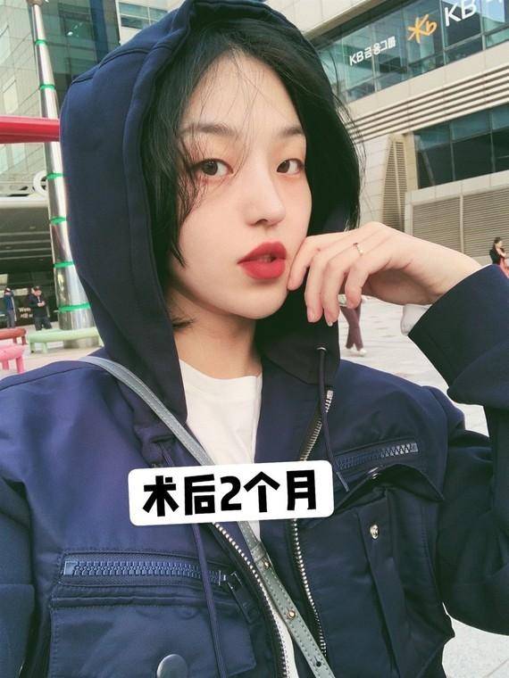 韩国医生整形日记:半肋软骨鼻修复案例分享