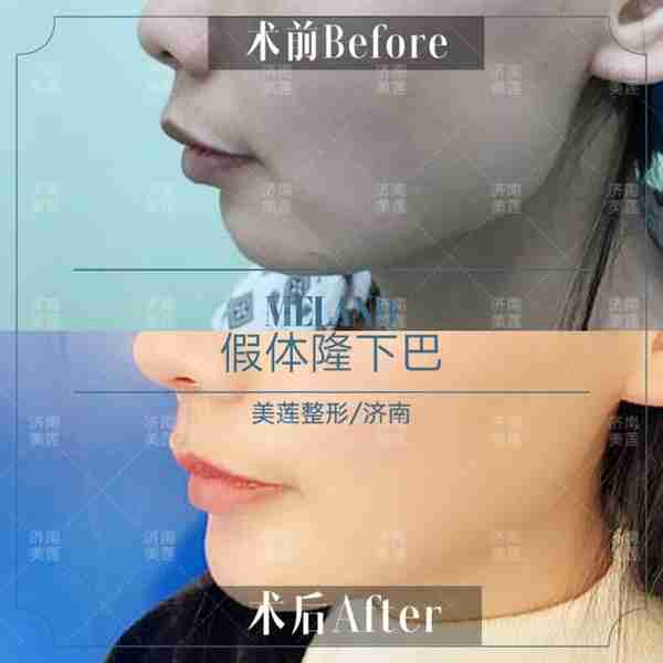 网红名利场,几百块打个瘦脸针,至少月入20多万