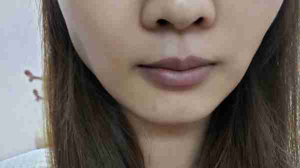 女子打瘦脸针后右脸咬肌凸出疑似“蛙腮”,深圳美莱回应