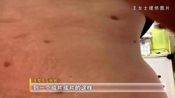 68万做“抽脂术”女子浑身长满黑色疤痕 后悔也来不及了