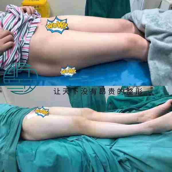 网红去世背后抽脂生意:腿部抽脂可达3万,“一天五到八台手术”
