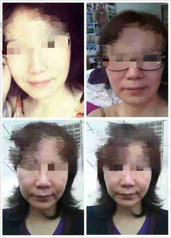 被瘦脸针“毁容”之后,索赔200万仅可得1万 法律保护健康但不保护美