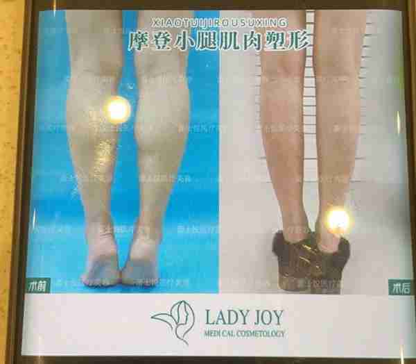 新闻多一度│女网红抽脂去世涉事医院负全责 谁在制造容貌焦虑?