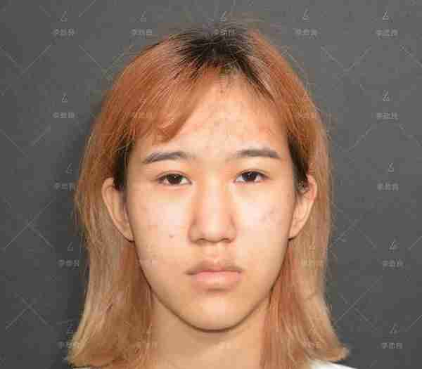 北京20岁女子被叫“大叔”,花6万做鼻子,术后换头,惊艳全家!