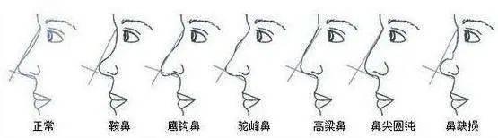 鼻子过短怎么整?