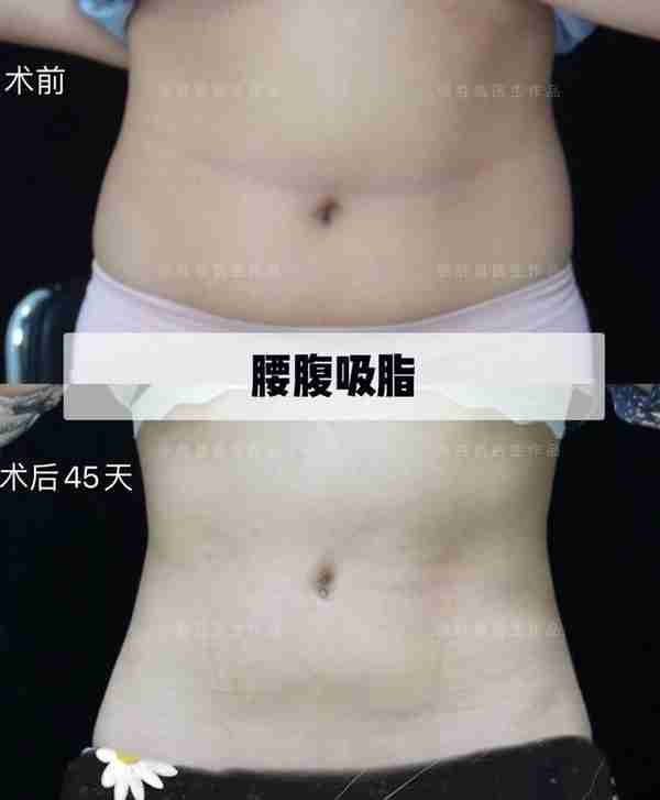 腰腹吸脂术后45天反馈