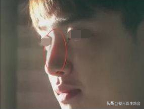 硅胶隆鼻是永久的吗?用它做鼻子有什么危害吗?