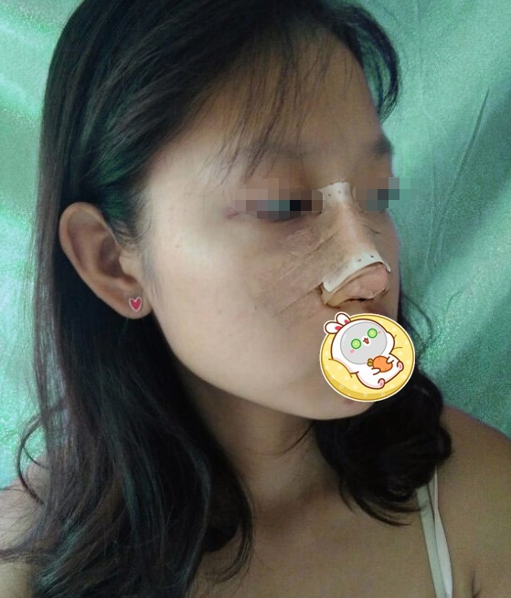 男朋友给20000叫我去隆鼻,我的鼻子真有那么难看吗