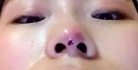 玻尿酸隆鼻VS线雕隆鼻