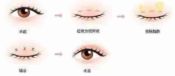 什么?你做的双眼皮竟然消失了