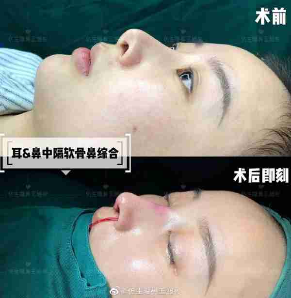 醒醒吧!L型假体隆鼻+耳软骨垫鼻尖,还在骗你是鼻综合