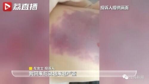 花6万元吸脂后皮肤坏死,双腿凹凸不平!还没修复好,整形医院去哪了?