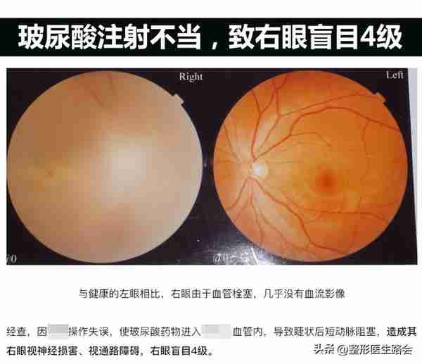 “玻尿酸隆鼻”是大热项目,简单快速,为什么我不建议大家做?