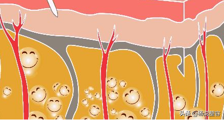 大腿吸脂手术,想要瘦腿的你知道多少?