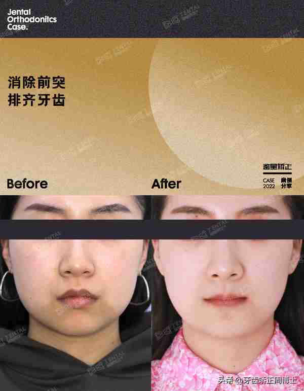 缺牙先别急着种!高性价比矫正案例,一次省去2颗种植费用