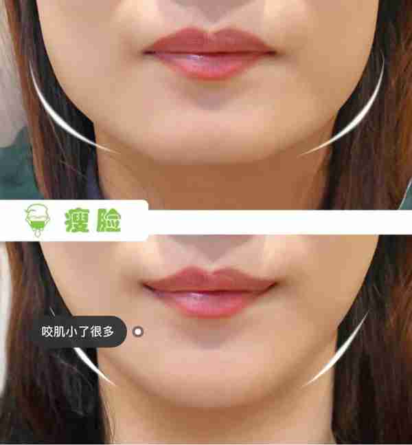 为什么打完瘦脸针会没有效果?了解完这些,帮你完美避雷