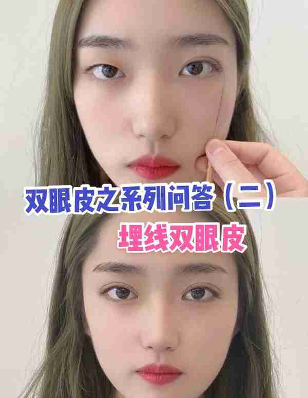 双眼皮快问快答(二):埋线双眼皮