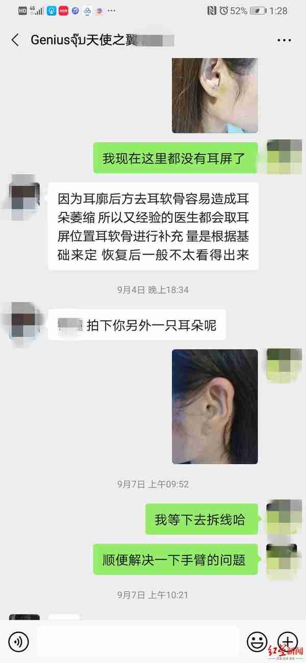 如此整形!取耳软骨做鼻头整形,鼻子好看了耳朵有个缺口 当事人:耳机都挂不住