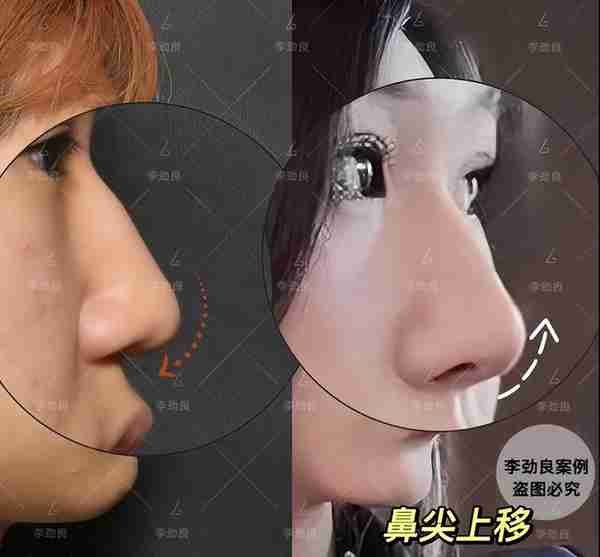 北京20岁女子被叫“大叔”,花6万做鼻子,术后换头,惊艳全家!