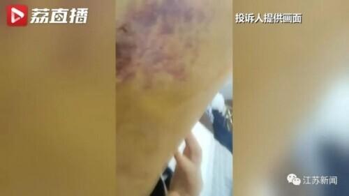 花6万元吸脂后皮肤坏死,双腿凹凸不平!还没修复好,整形医院去哪了?