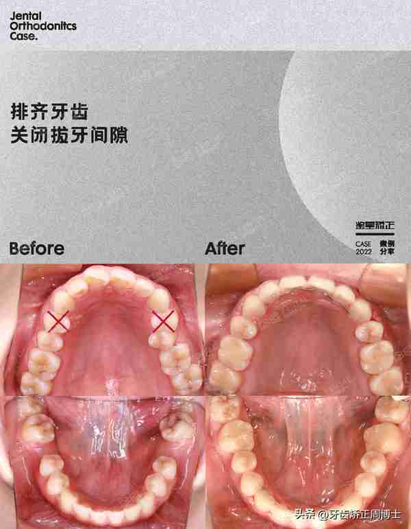 缺牙先别急着种!高性价比矫正案例,一次省去2颗种植费用