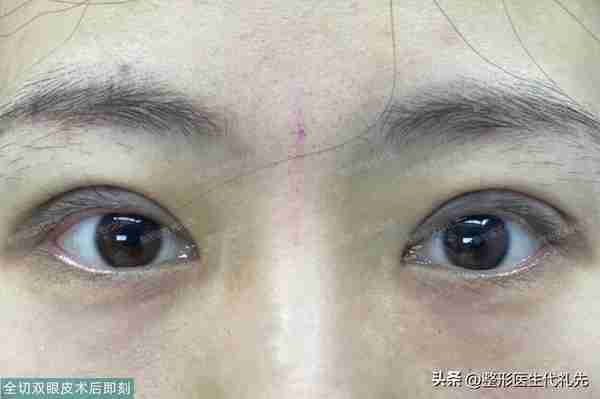 40岁来北京全切开扇形双眼皮,术后半年真实自然,气质180度提升