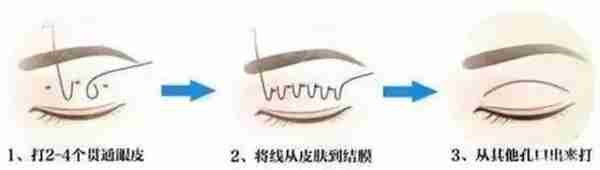 什么?你做的双眼皮竟然消失了