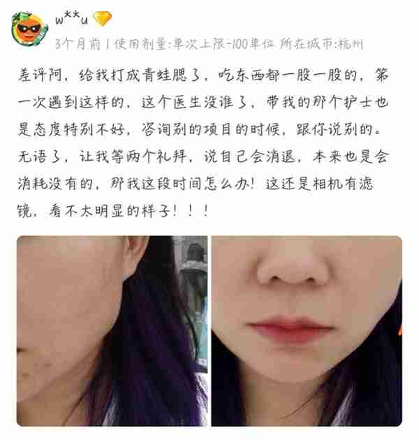 女子打瘦脸针后右脸咬肌凸出疑似“蛙腮”,深圳美莱回应