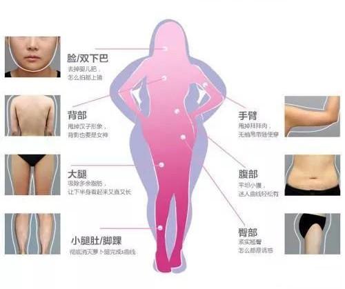 想全身吸脂怎么办?看完这篇你就知道专业吸脂医生是怎样规划的了