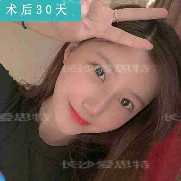 现在耳软骨隆鼻多少钱?恢复需要多长时间?可以维持多久?