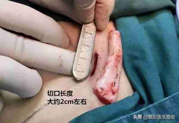 盘点3大类10种隆鼻材料,看看哪种最安全,效果保持最久?