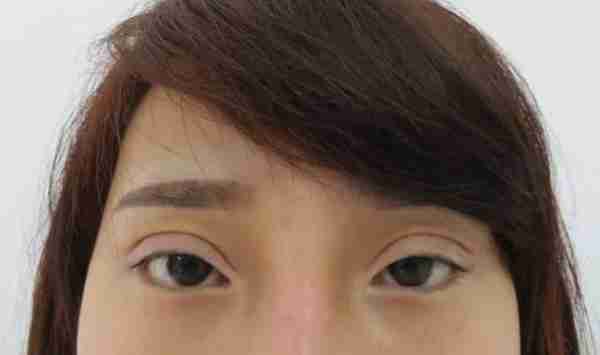 双眼皮手术后不好看,再修复一下不就行了吗?