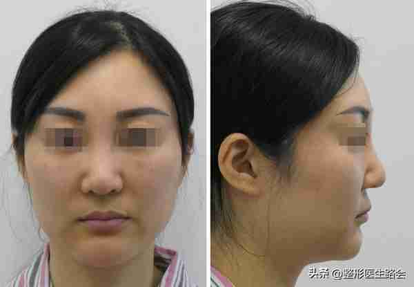 “玻尿酸隆鼻”是大热项目,简单快速,为什么我不建议大家做?