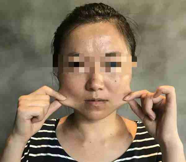 被瘦脸针“毁容”之后,索赔200万仅可得1万