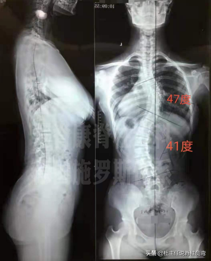 青少年特发性脊柱侧弯,可以做训练来减少侧弯度数的发展吗?