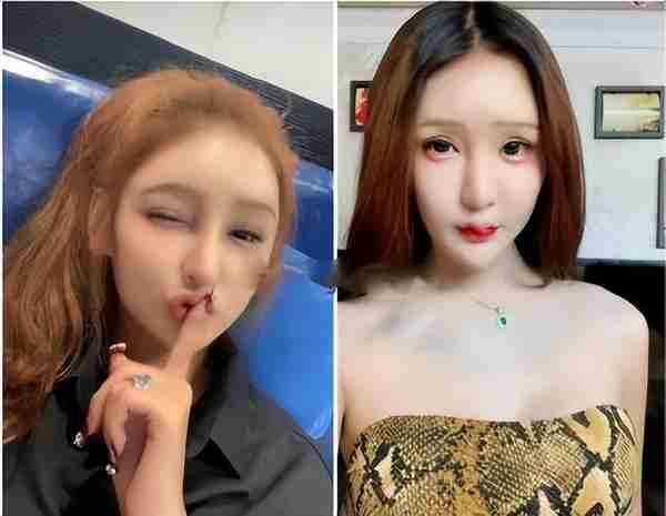 整容失败?网红脸内注射400多针玻尿酸:夏天会融化,冬天会冻住