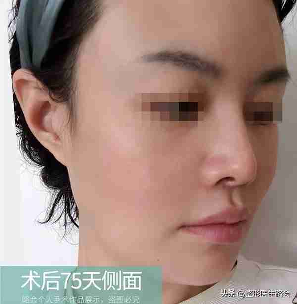 30岁+女士赴京整形,膨体隆鼻+鼻基底填充全记录,5个月后大变样
