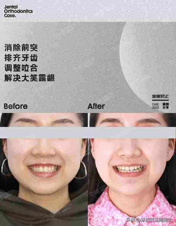缺牙先别急着种!高性价比矫正案例,一次省去2颗种植费用