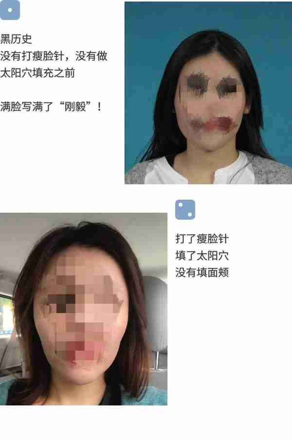 玻尿酸填充面颊，葫芦脸变鹅蛋脸