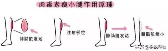 大腿吸脂手术,想要瘦腿的你知道多少?