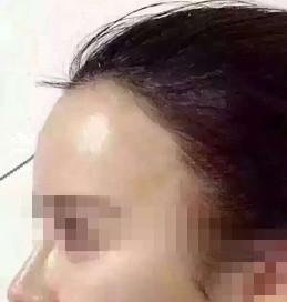 珍藏已久的面部自体脂肪填充攻略