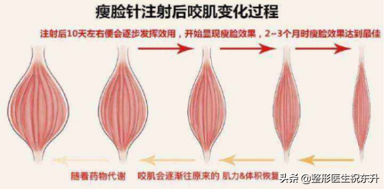 网上那么多“打完瘦脸针,出现面部僵硬、凹陷的”,我都不敢打了