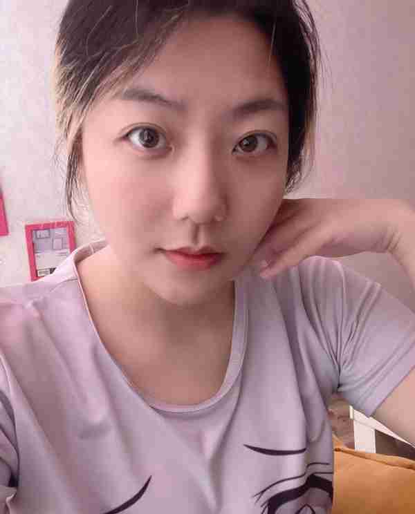 30岁小姐姐做完面部吸脂60天,朋友还以为我悄悄地换了一张脸