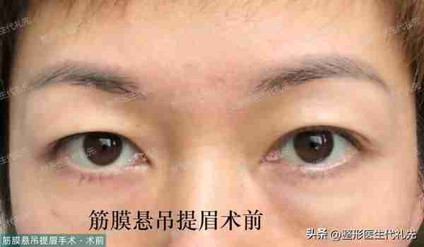 49岁眼皮松弛做提眉还是全切双眼皮?女士选择提眉手术,术后13天