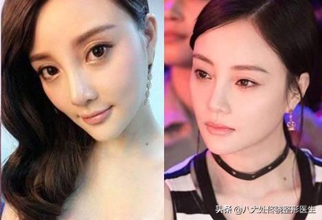 面部一枝花,全靠鼻当家,“一支玻尿酸”解救娱乐圈无数塌鼻梁