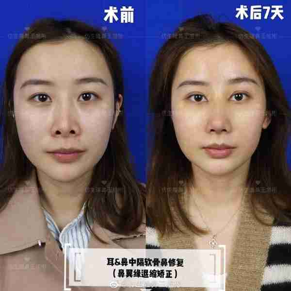 醒醒吧!L型假体隆鼻+耳软骨垫鼻尖,还在骗你是鼻综合