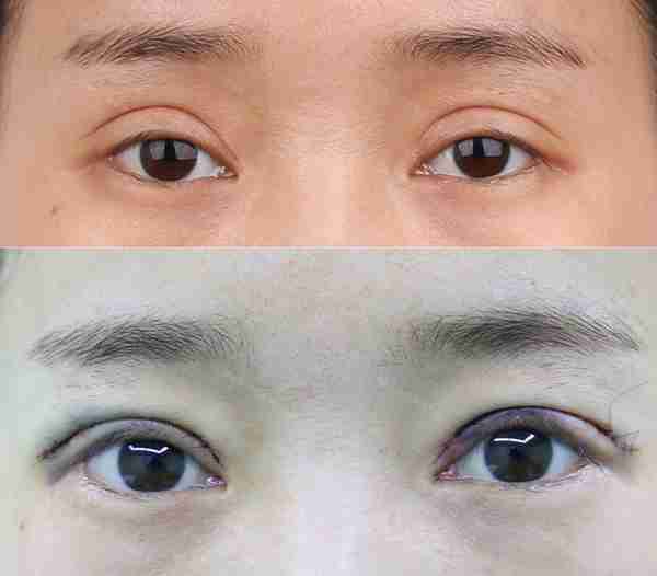 做双眼皮要花多少钱?怎么判断要不要开眼角?有哪些注意事项?