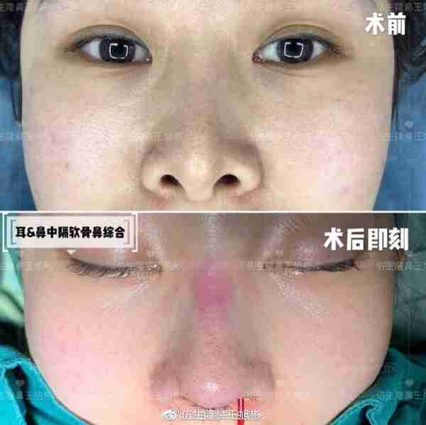 醒醒吧!L型假体隆鼻+耳软骨垫鼻尖,还在骗你是鼻综合