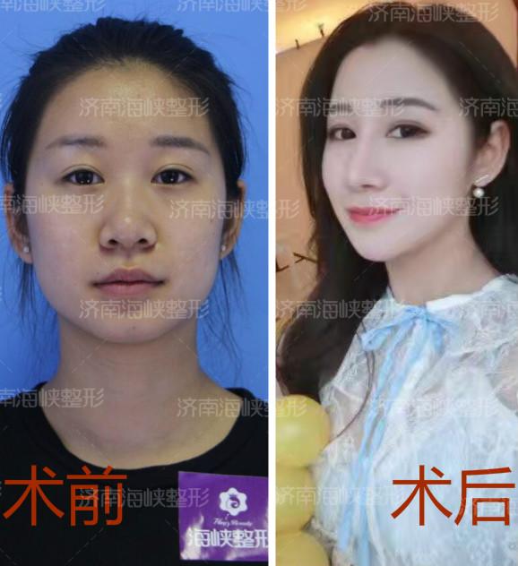 隆鼻假体可以用一辈子吗,你还敢去做吗?