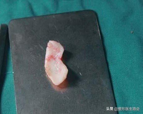 盘点3大类10种隆鼻材料,看看哪种最安全,效果保持最久?